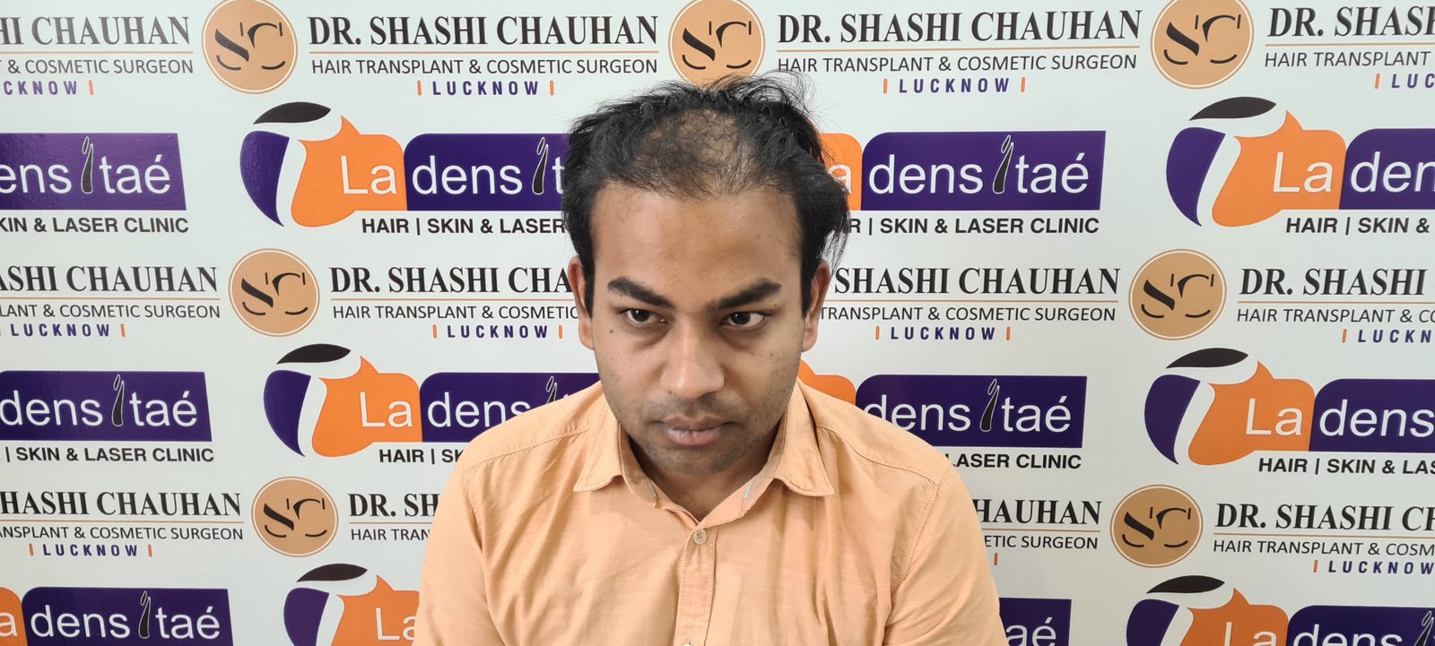 Arnav Dayal Before Hair Transplant